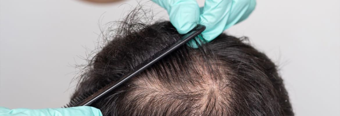 Can PRP Help With Hair Loss? post